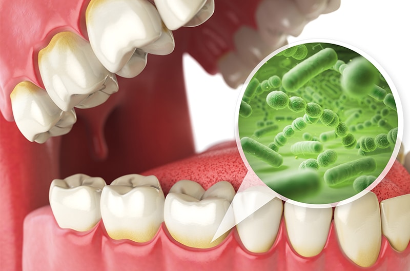 蛀牙原因-牙齒痛原因-預防蛀牙-蛀牙治療-台中朗日牙醫