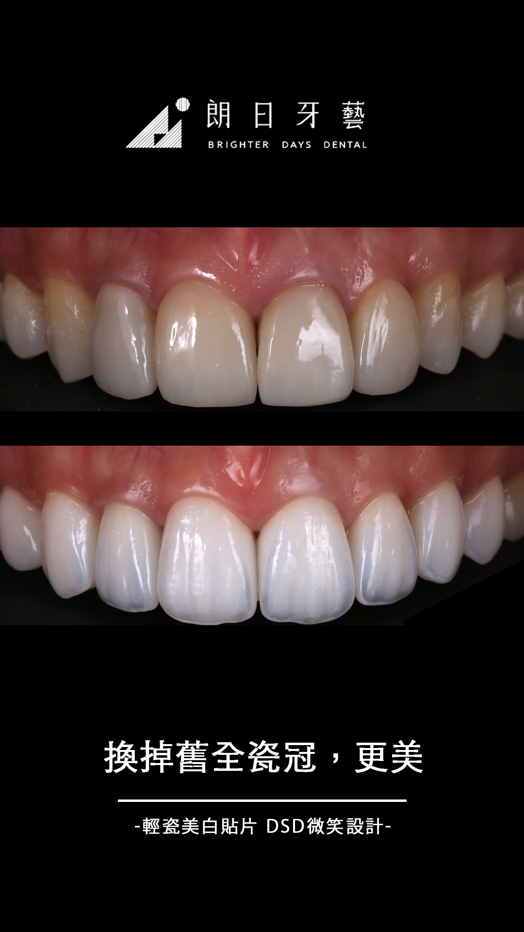 全瓷冠都一樣嗎 台中朗日牙藝做的全瓷冠更自然更白更美 朗日牙醫 台中陶瓷貼片推薦