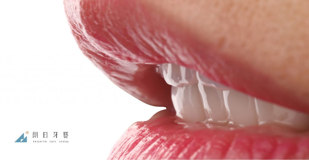 比牙齒矯正更快更美的瓷牙貼片牙齒整型心得推薦-台中牙齒美白-朗日牙醫