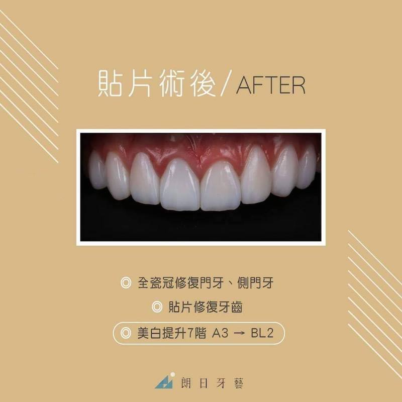 假牙不密合-變色-變黑-全瓷冠-陶瓷貼片-DSD微笑設計--療程後-朗日牙醫-台中