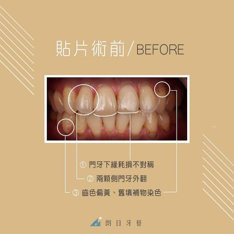 陶瓷貼片-推薦-台中-朗日牙藝-dsd數位微笑設計-牙齒微整型-Doris在陶瓷貼片療程前的牙齒狀況