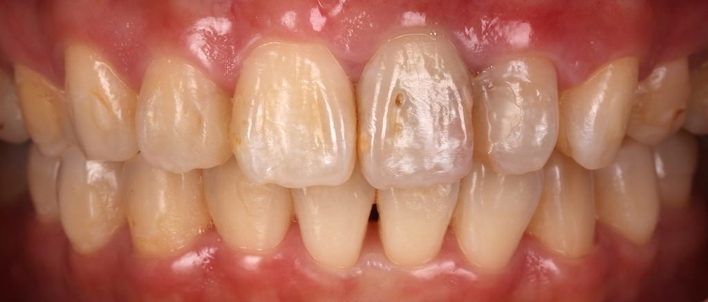 陶瓷貼片-推薦-台中牙醫診所-朗日牙藝-DSD數位微笑設計-台北ＭS朱-療程前門牙根管治療-牙齒黃-補牙-牙齒正面照