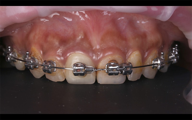陶瓷貼片-戴牙套矯正後-牙齒黃-門牙有縫-牙齒美白前-台中-朗日牙醫