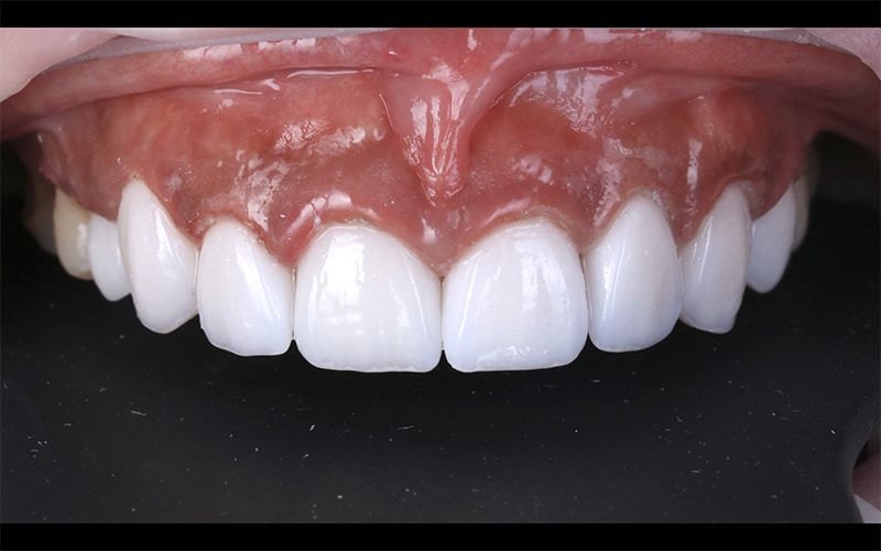 陶瓷貼片-戴牙套矯正後-牙齒黃-門牙有縫-牙齒美白後-DSD數位微笑設計-台中-朗日牙醫