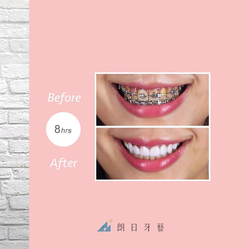 陶瓷貼片-戴牙套矯正後-牙齒黃-門牙有縫-牙齒美白前後比較-台中-朗日牙醫
