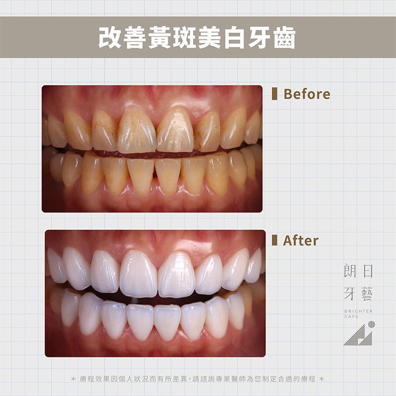 陶瓷貼片推薦必看q A 輕瓷美白貼片懶人包 台中朗日牙醫