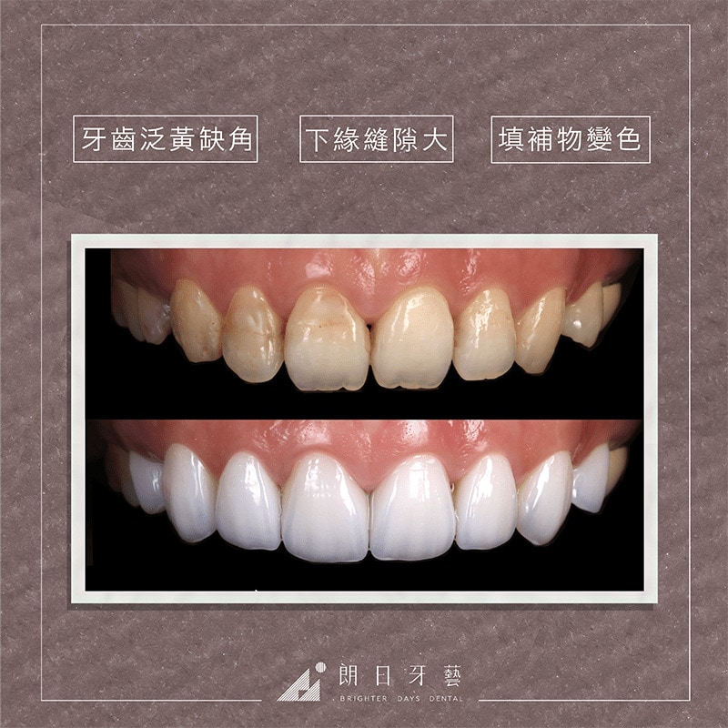 台中陶瓷貼片-輕瓷美白貼片-推薦案例-牙齒黃-牙齒缺角-補牙變色