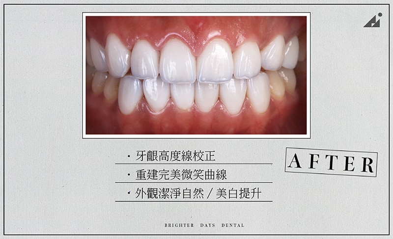 陶瓷貼片-牙齒美白-微笑曲線牙齒-牙齦整型-療程後-朗日牙醫-台中