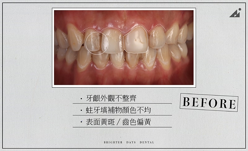 陶瓷貼片-牙齒黃-牙齦高度不一-蛀牙補牙變色-療程前-朗日牙醫-台中