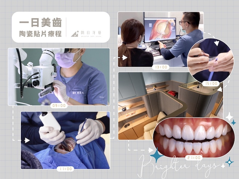 牙齒貼片失敗-陶瓷貼片後悔-一日美齒-陶瓷貼片-療程-台中-朗日牙醫