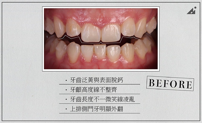 陶瓷貼片矯正-療程前-牙齒黃-牙齒亂-門牙外翻-朗日牙醫-台中