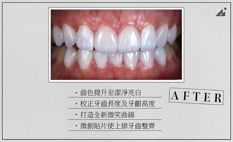 陶瓷貼片矯正-療程後-牙齒美白-微笑曲線牙齒-朗日牙醫-台中