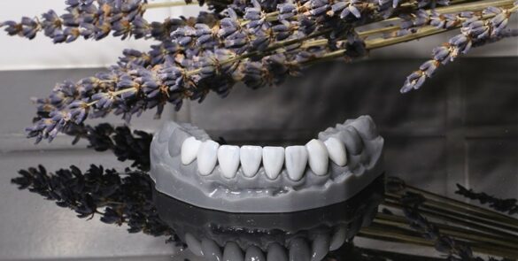 陶瓷貼片-全瓷冠-牙齒美白-朗日牙藝-台中牙醫