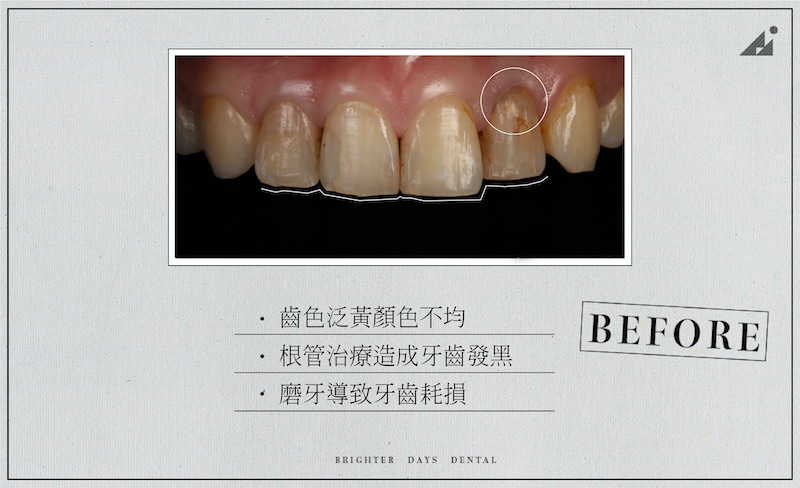陶瓷貼片-磨牙-牙齒磨損-抽神經牙齒變黑-一日美齒-療程前-朗日牙醫-台中