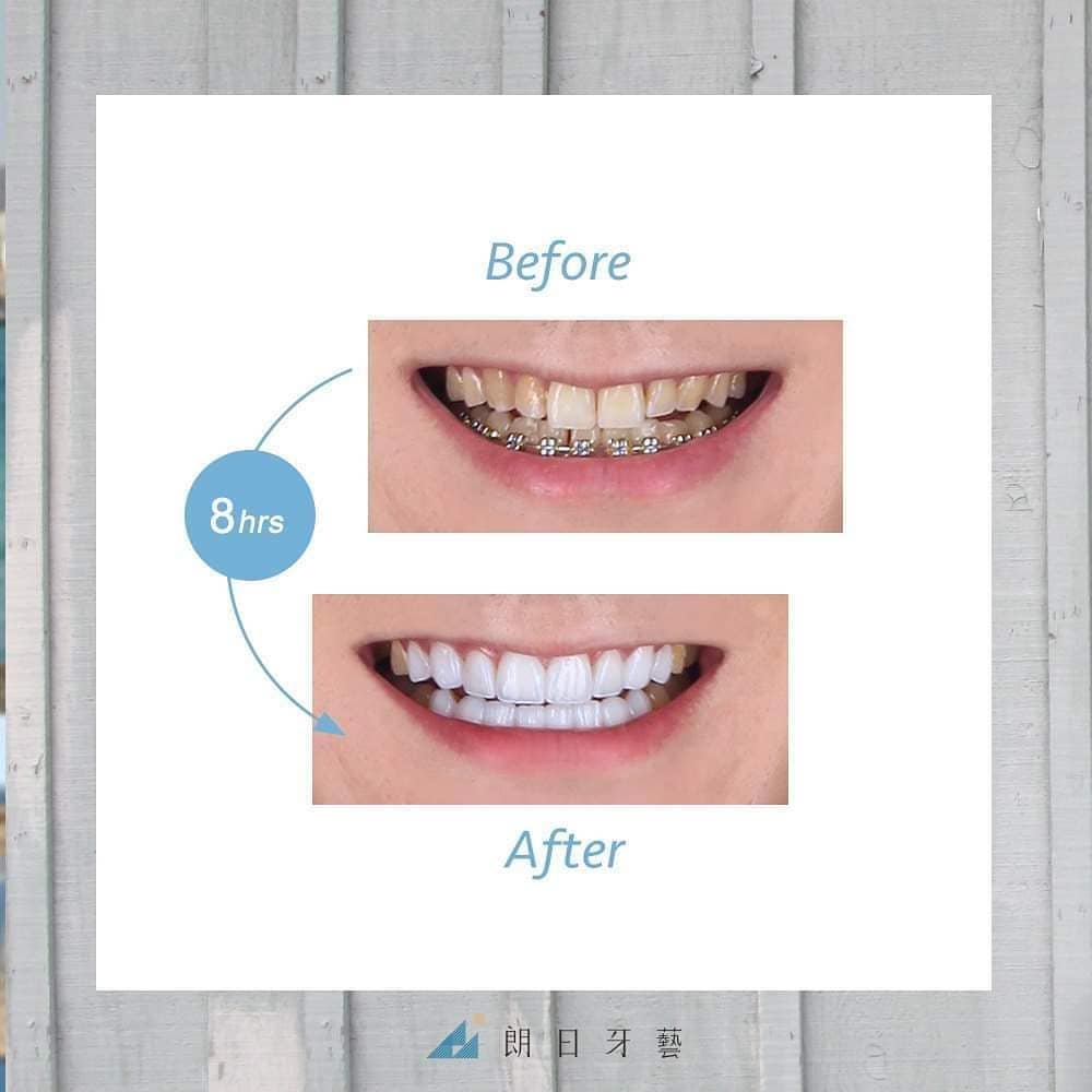 牙齒黃-牙齒矯正美白-dsd數位微笑設計-陶瓷貼片前後微笑曲線比較-朗日牙醫-台中
