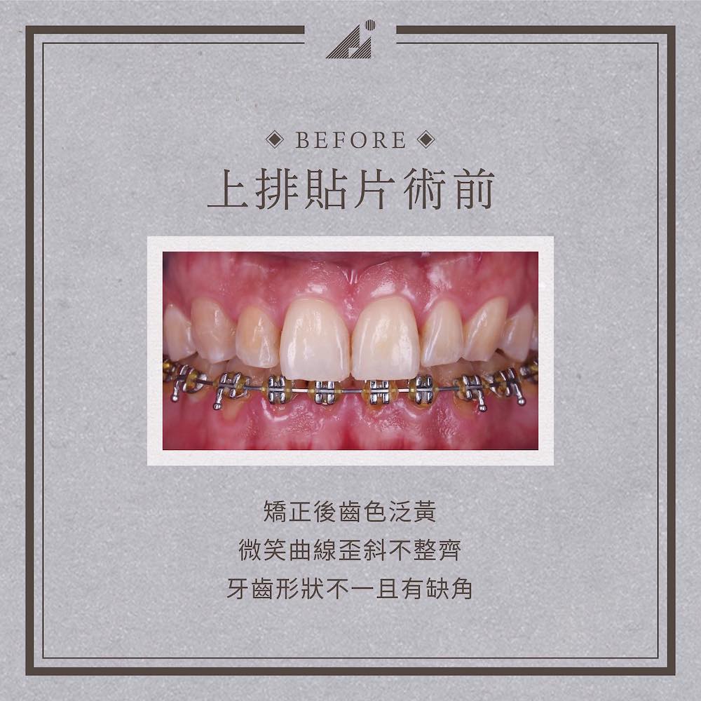 牙齒黃-牙齒矯正美白-陶瓷貼片前-前牙外觀-朗日牙醫-台中