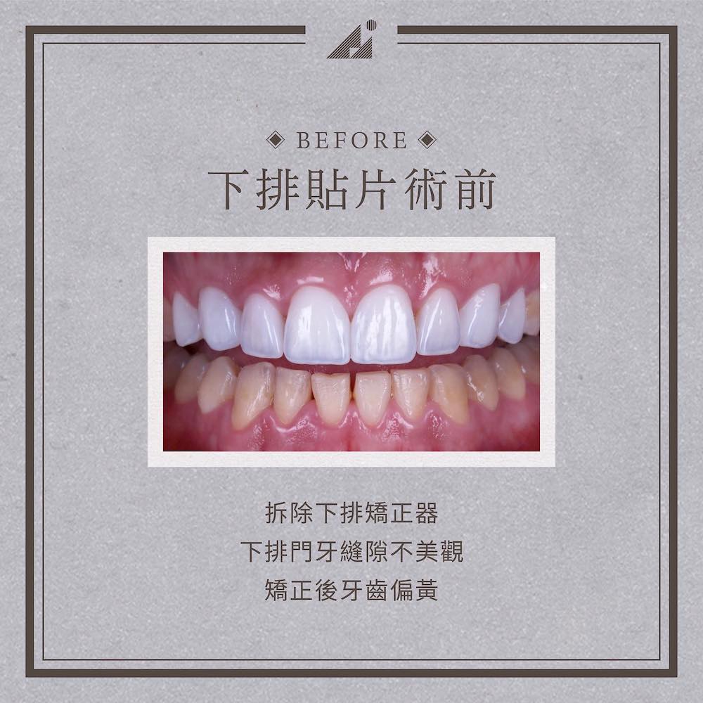 牙齒黃-牙齒矯正美白-陶瓷貼片術前-下排牙齒-牙縫大-朗日牙醫-台中