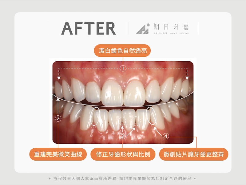 採陶瓷貼片治療四環素牙，治療後牙齒顏色自然透亮且有完美微笑曲線