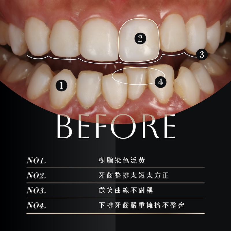 網紅杜衫杉陶瓷貼片療程前的牙齒狀況，有樹脂貼片染色泛黃、牙齒形狀短方、微笑曲線不對稱、下排牙齒嚴重擁擠不整齊等問題