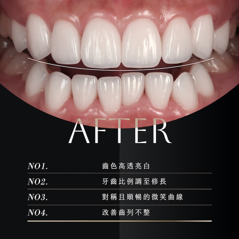 台中朗日牙醫劉得廷醫師為網紅杜衫杉拆除樹脂貼片換上陶瓷貼片，齒色變得白皙透亮，牙齒比例更修長；上排牙齒微笑曲線更加對稱順暢，並改善下排齒列不整