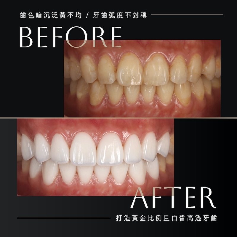 喝咖啡牙齒黃-牙齒美白-陶瓷貼片-壽命-療程前後牙齒變化對比-朗日牙醫-台中
