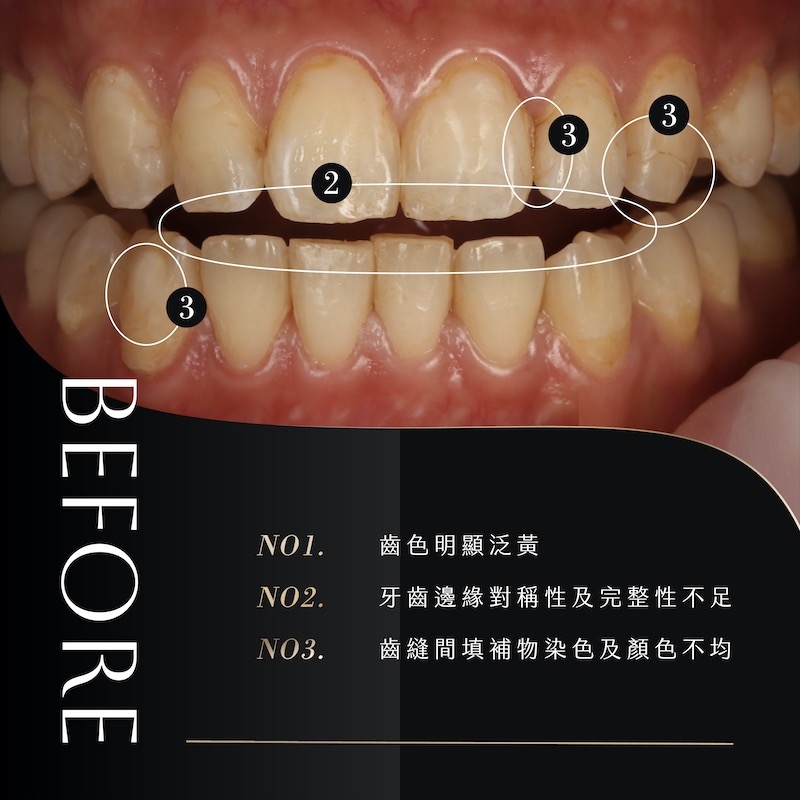 喝咖啡牙齒黃-牙齒美白-陶瓷貼片-壽命-療程前牙齒近照-朗日牙醫-台中
